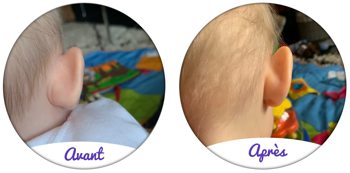 Oreille de bébé avant et après le port du bonnet